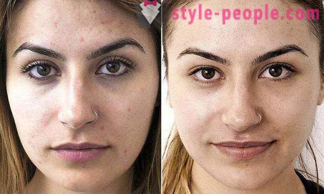Hollywood Peeling: types of procedures and results