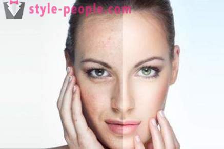 Azelaic acid peels: reviews cosmetologists, photos before and after