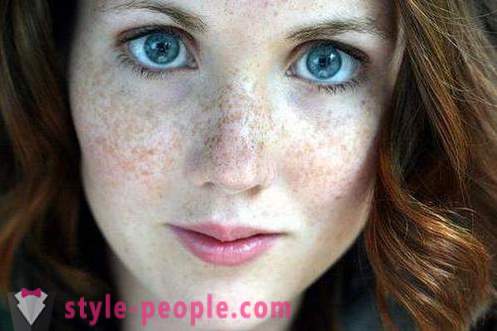 How to get rid of freckles? Best cream and folk remedies for freckles