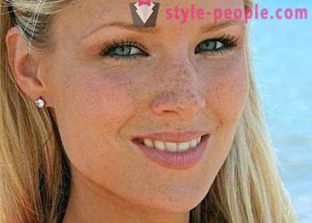 How to get rid of freckles? Best cream and folk remedies for freckles