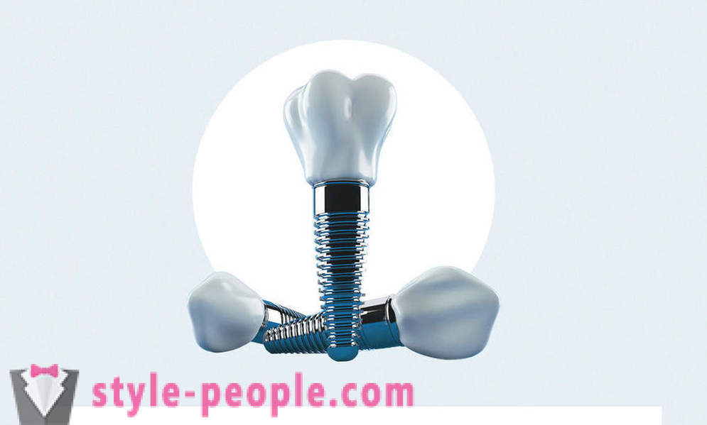 8 questions about dental implants