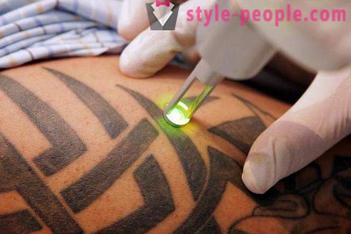 Laser tattoo removal. Reviewed the