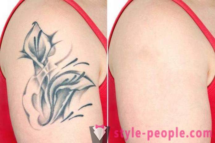 Laser tattoo removal. Reviewed the