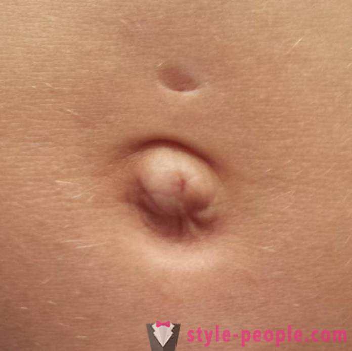 Is it possible to pierce the belly button? It hurts if pierced navel?