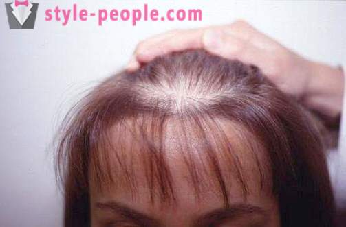 Darsonval hair. Application darsonvalya for the treatment and prevention of hair loss