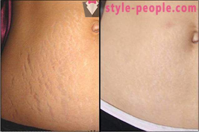 How to choose a cream for stretch marks: tips and reviews