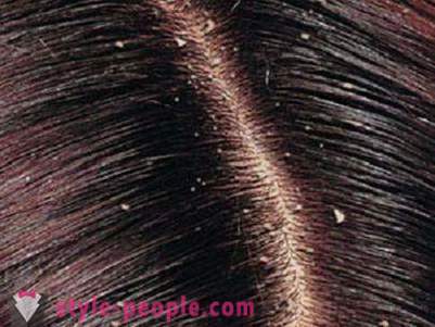 Dandruff Shampoos: objective rating. Medicated shampoos for dandruff: reviews, prices
