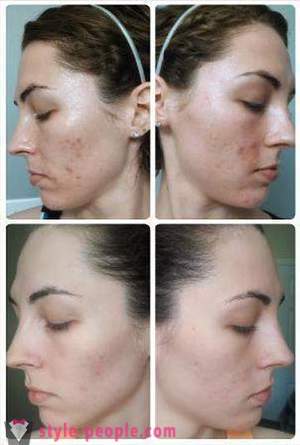 Salicylic peels: reviews, prices. Salicylic peels at home