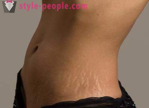 How to get rid of stretch marks in the home: tips and tricks