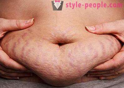 How to get rid of stretch marks in the home: tips and tricks