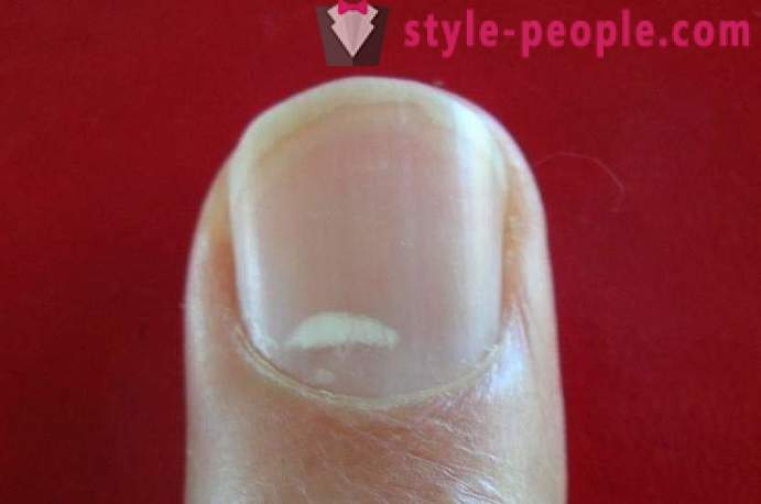 What do the white spots on the nails