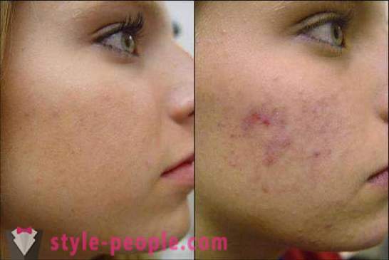 We treat acne scars