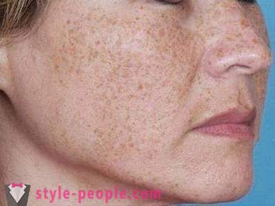 Brown spots on the face: the causes of and the fight against them