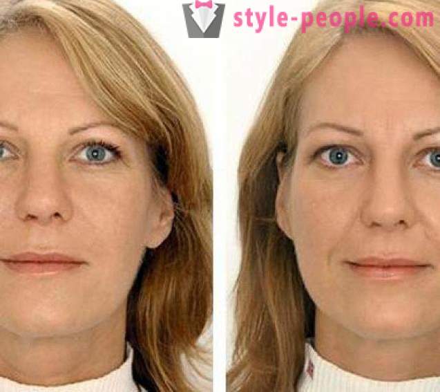 How to effectively remove the nasolabial folds: in the cabin or home remedies?