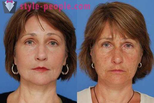 Laser resurfacing of the face - a safe way to rejuvenate