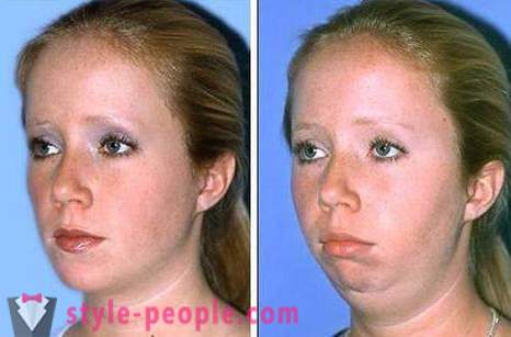 How to remove the cheeks without surgery